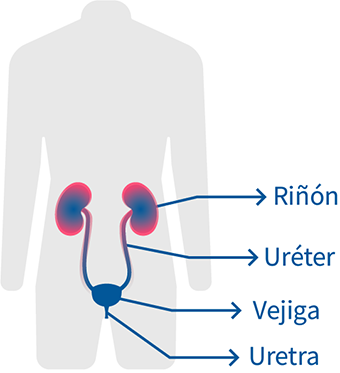 pielonefritis