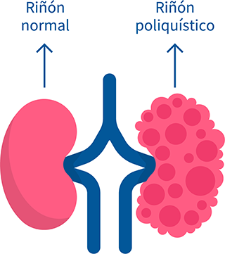 poliquistosis renal