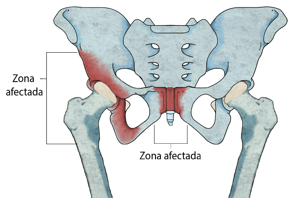 Pubalgia