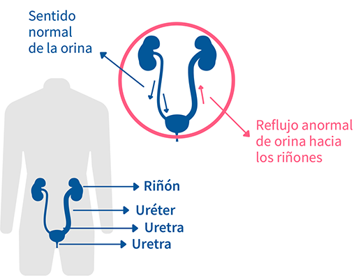 reflujo vesicoureteral