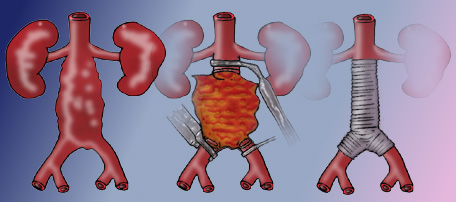 Aorta abdominal