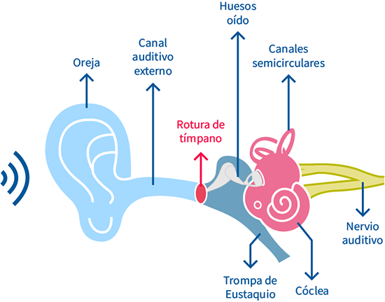 rotura timpano