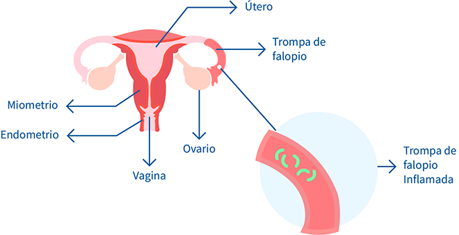 salpingitis