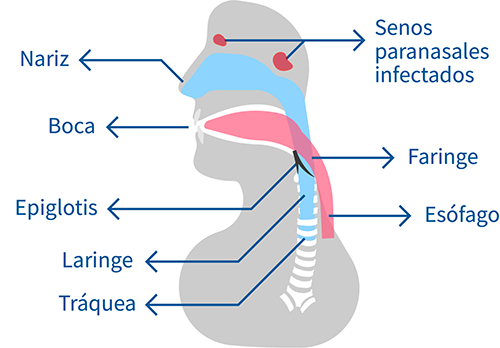 sinusitis