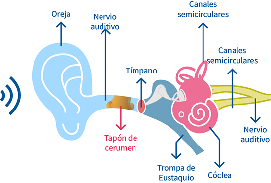 tapon cerumen