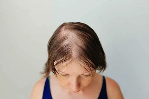 Alopecia areata