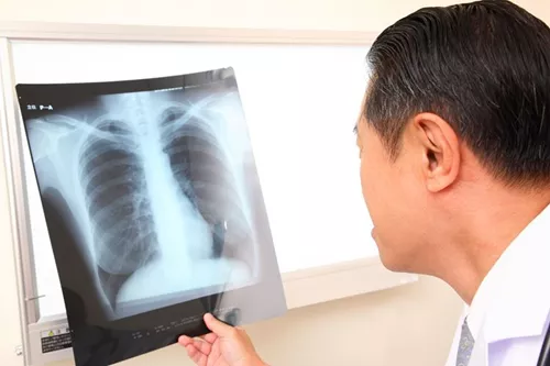 Cáncer de pulmón de células grandes