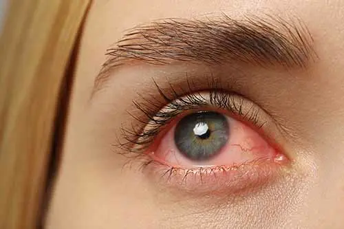 Conjuntivitis alérgica