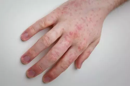 Dermatitis de las manos