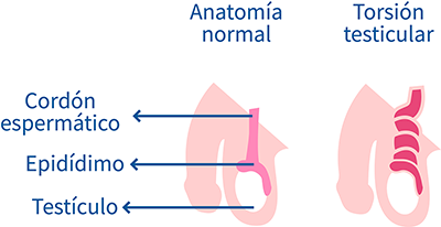 Torsión testicular